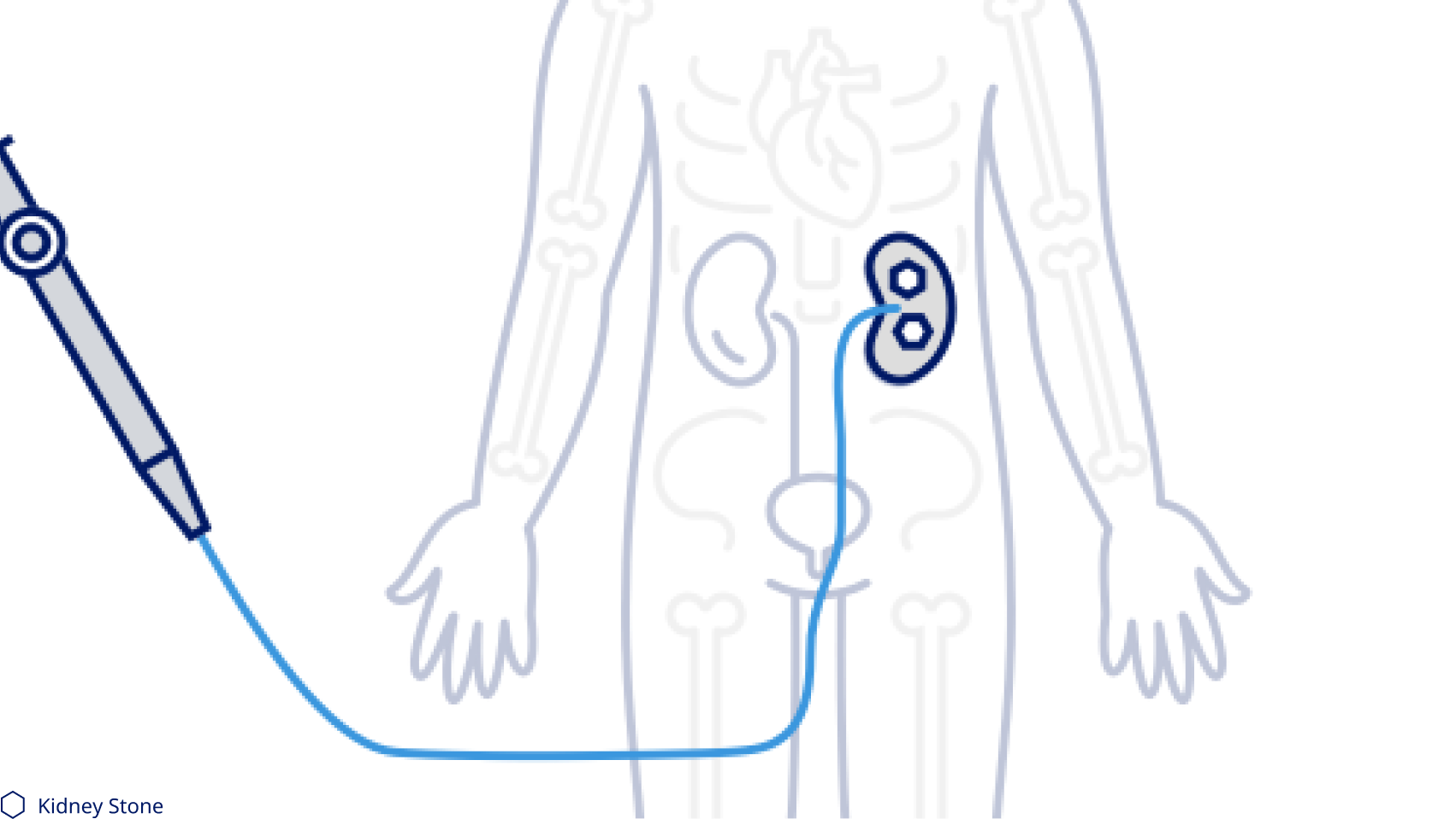 Kidney stone removal ureteroscopy