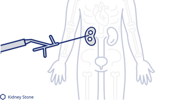 Kidney stone removal ureteroscopy