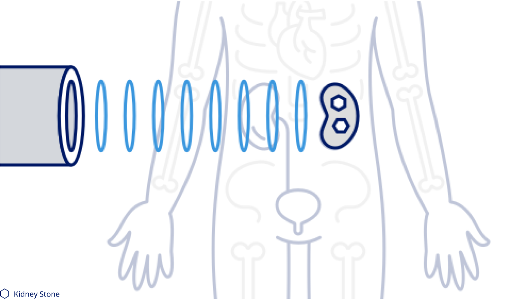 Kidney stone removal ureteroscopy