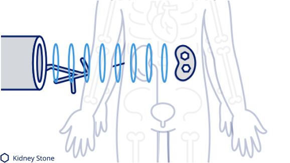 Kidney stone removal ureteroscopy