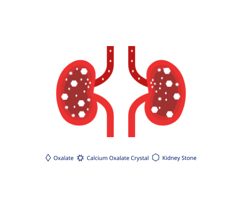 Crystal formation and stones in the kidneys