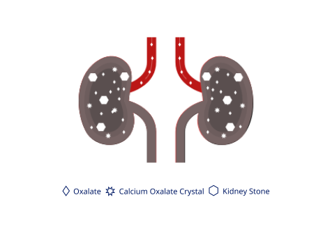 Later stages of CKD